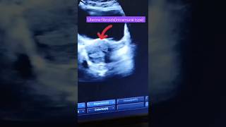 Uterine fibroidsultrasound imagesfibroidsintramural typeytshortshortvideo [upl. by Yaron7]