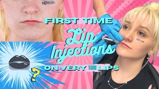 Getting Lip Fillers for the first time 👄💉  Very Thin Lips  Before During amp After [upl. by Gwenora]