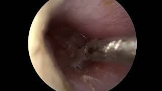 Ear tube placement myringotomy [upl. by Sholes727]