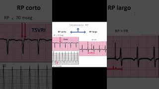 Cómo Identificar Tipos de Taquicardia en el Electrocardiograma  Dr Jose Porto [upl. by Llenehs]