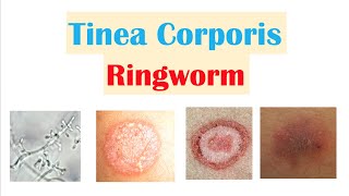 Ringworm Tinea Corporis  Causes Risk Factors Signs amp Symptoms Diagnosis and Treatment [upl. by Robinson]