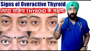 Rx Thyroid 4 Hindi ज्यादा सक्रिय थाइरोइड के लक्षण  Hyperthyroidism  DrEducation [upl. by Llenrod]