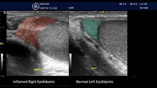 Acute Epididymitis  PointofCare Ultrasound [upl. by Farra]