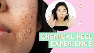 ✂ Chemical Peel for Acne amp Scars Before amp After [upl. by Nealah563]