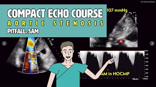 〖Echocardiography〗 LVOT obstruction amp SAM  pitfalls in aortic stenosis 🚨 [upl. by Niatsirk]