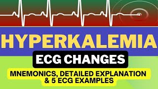 Hyperkalemia ECG Changes Interpretation Mnemonics and Hyperkalemia ECG Examples [upl. by Rida]