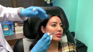 Contouring the Jaw with Facial Fillers [upl. by Veradi]