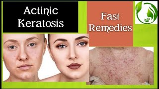 Actinic keratosis treatment guide from a Dermatologist [upl. by Nileak]