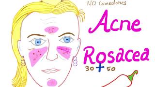 Acne Rosacea [upl. by Azar]