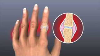 Rheumatoid Arthritis  Treatment  Johns Hopkins [upl. by Naenaj]