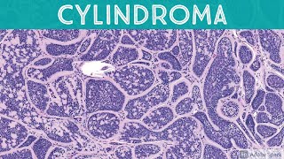 Cylindroma 5Minute Pathology Pearls [upl. by Eiralam741]