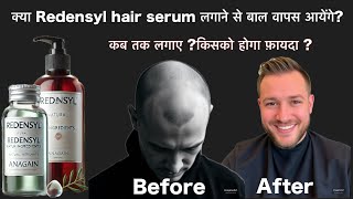 क्या Redensyl hair serum लगाने से बाल वापस आते है  Redensyl बंद करने पर क्या बाल चले जाएँगे [upl. by Nitsej]