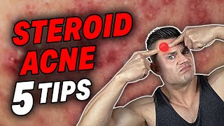 Got HORRIBLE Acne Or Bacne On Steroids Watch This [upl. by Eldnek188]