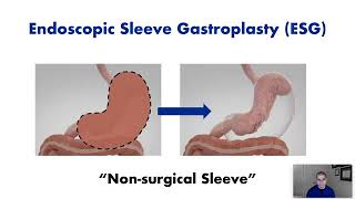 Endoscopic Sleeve Gastroplasty ESG  Procedure Overview [upl. by Crandale]