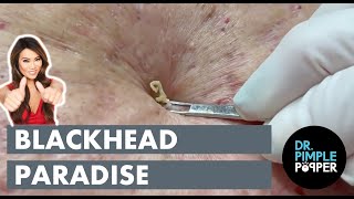 Blackhead Paradise [upl. by Danas]