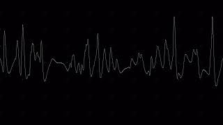 Electromyography EMG amp Nerve conduction studies NCS [upl. by Pul]