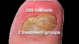 Nail Lacquer Shown Effective for Toenail Fungus [upl. by Bora]