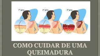 Como cuidar de uma queimadura [upl. by Godding538]