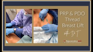 NonSurgical Breast Lift With PRP amp PDO Threads [upl. by Kirred]