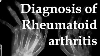 Rheumatoid arthritis diagnosis [upl. by Thaddus]