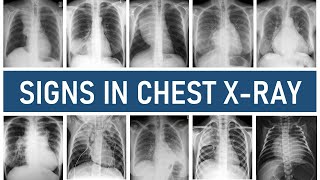 Signs in Chest Xray [upl. by Odlanra]