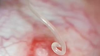 Theres a worm in my eye Loa Loa worm removed from eye in Austin TX Shannon Wong MD 3102016 [upl. by Lraep]