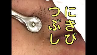 ニキビ潰し にゅるっと4連発【閲覧注意】acne treatment in Japan [upl. by Gavra]