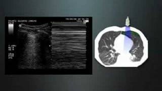 Pulmonary Ultrasound in Dyspnea [upl. by Neersin466]