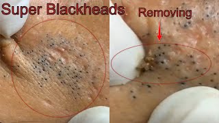 Super pimples amp Blackheads Extraction On face Acne Treatment Satisfying Cystic Acne [upl. by Miarfe]