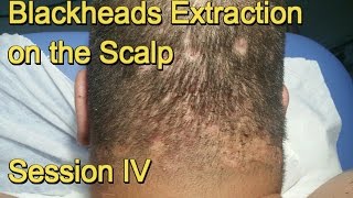 Blackheads Extraction on the Scalp  Session IV [upl. by Ninetta]