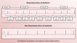 Advanced EKGs  Sinus Node Dysfunction [upl. by Pisano]