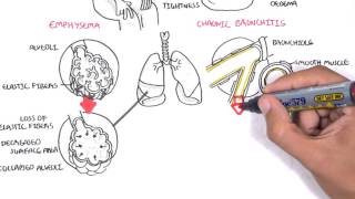 Chronic Obstructive Pulmonary Disease Overview types pathology treatment [upl. by Ynogoham]