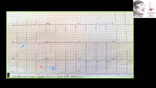 digoxin effect toxicity [upl. by Nivlem]