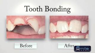 Cosmetic Bonding in Beirut Lebanon  Dentist Lebanon [upl. by Cynde]