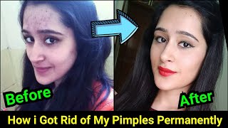 How to Remove Pimples Acne Pimple Marks completely  ThatGlamGirl [upl. by Dunlavy]