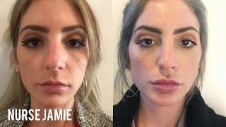 Before and After Micro Needling  Nurse Jamie [upl. by Wiggins]