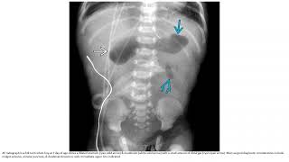 Duodenal Atresia or Stenosis Imaging [upl. by Coney]