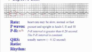 ECG 1st Degree AV Block [upl. by Katti]