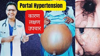 portal hypertension sign and Symptoms and management [upl. by Amelia]