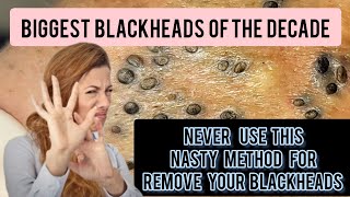 Nasty and lengthy blackhead removal bent needle historical method DrAMAZINGSKIN [upl. by Ailliw]