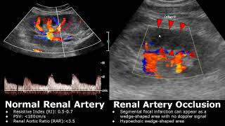 Renal Artery Doppler Ultrasound Normal Vs Abnormal Images  StenosisOcclusionAVM  Kidney USG [upl. by Koah]