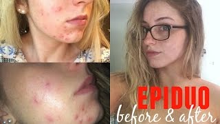 Epiduo Before and After Review amp Tips [upl. by Hyps]