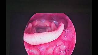 laryngeal papilloma papillomavirus hoarseness cough entsurgeon drbaisalisarkar kolkata [upl. by Jarrad]