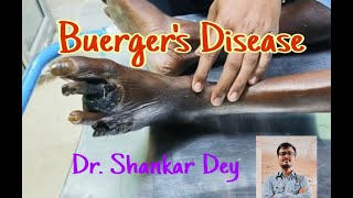 Buergers Disease  Case Demonstration  Dr Shankar Dey [upl. by Brockie]