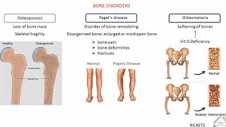 BONE DISORDERS AND TREATMENT [upl. by Enaud582]