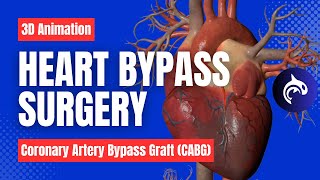 CABG Surgery  A Visual Journey through Coronary Artery Bypass Graft CABG Surgery meddco [upl. by Ahsehyt]