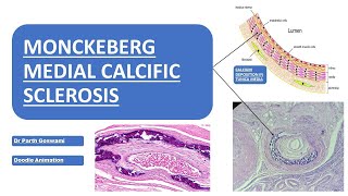 Monckeberg Medial Calcific Sclerosis  Doodle Animation  Images  Made Easy [upl. by Brick510]