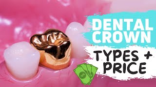 Dental Crowns Explained  WATCH BEFORE YOUR CROWN PROCEDURE [upl. by Domingo]