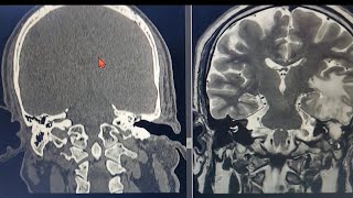 Ear Infection 👂 Leading into BRAIN infection 🧠 Radiology ent skull neurosurgeon [upl. by Enneyehc839]