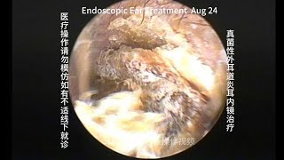 Endoscopic treatment of fungal otitis externa [upl. by Cosette997]